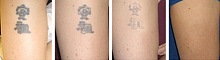 Odstranění tetování 5